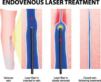 Varicose Veins in Pregnancy - Liverpool Varicose Veins Clinic